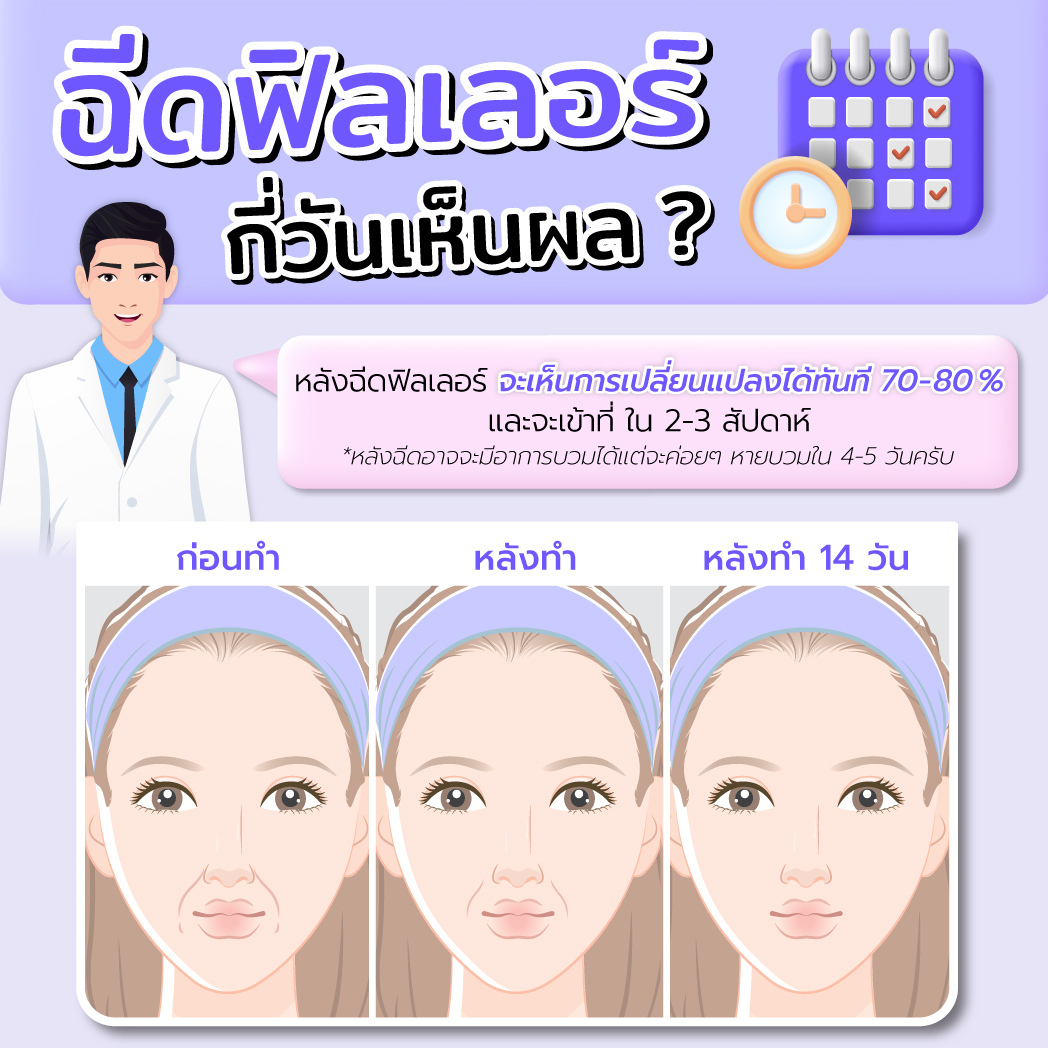 ฉีดฟิลเลอร์กี่วันเห็นผล