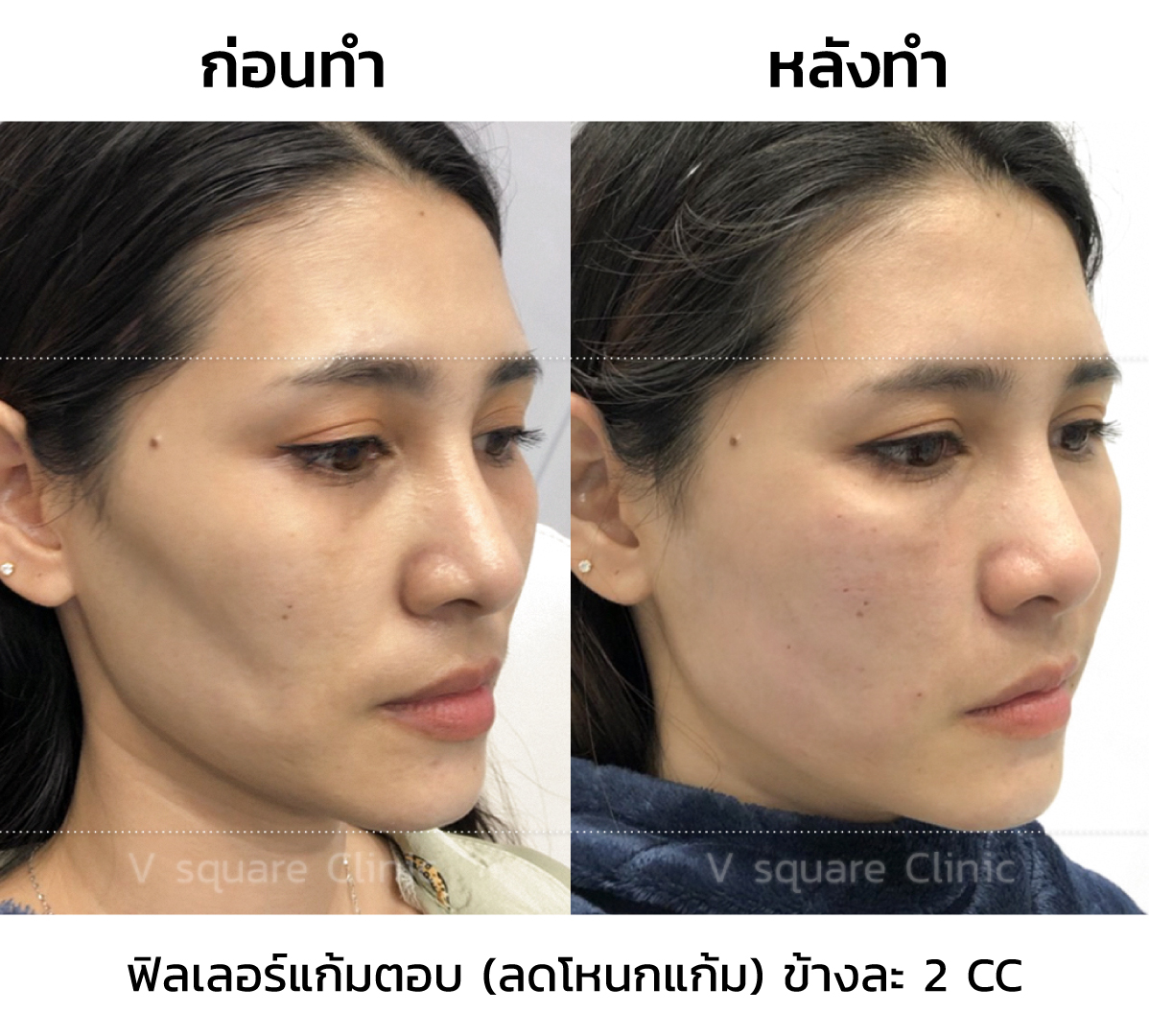 รีวิว ฟิลเลอร์แก้มตอบ