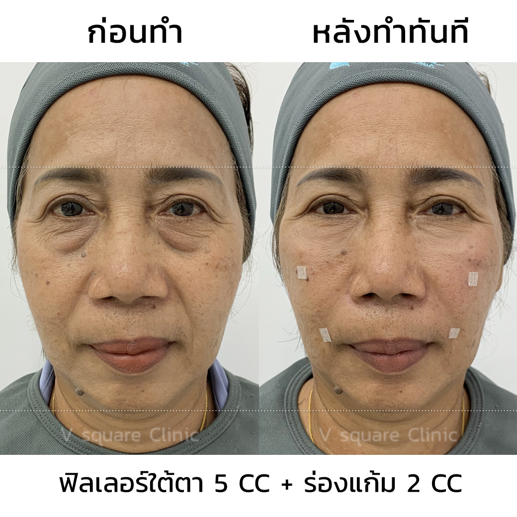 รีวิว ฟิลเลอร์ใต้ตา ร่องแก้ม