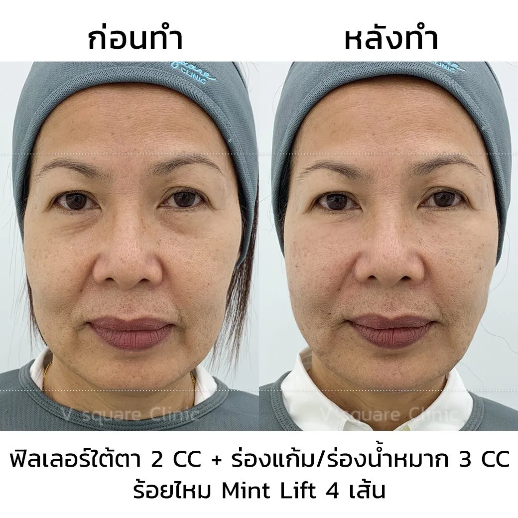 รีวิวการฉีดฟิลเลอร์ Juvederm