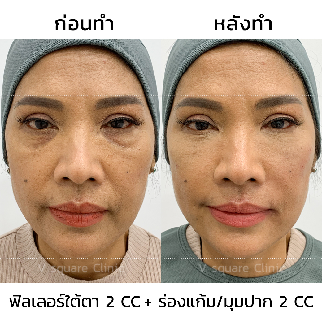 รีวิวการฉีดฟิลเลอร์ Juvederm