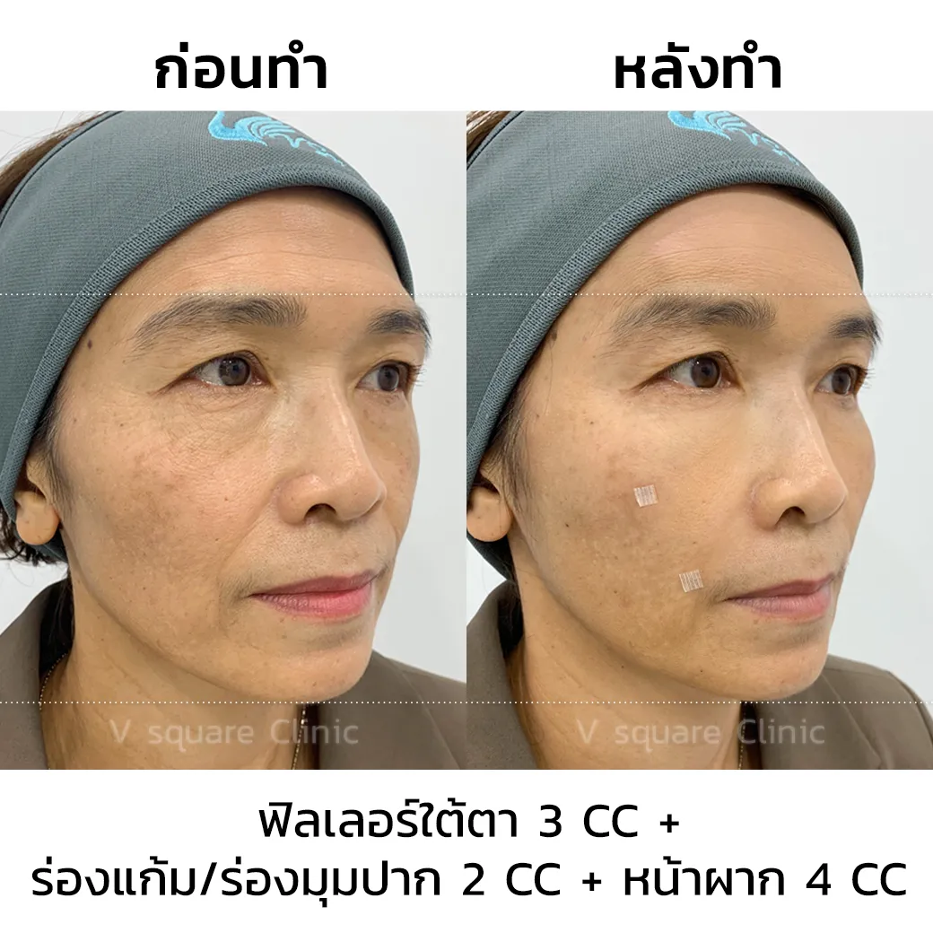 รีวิวการฉีดฟิลเลอร์จูวีเดิม