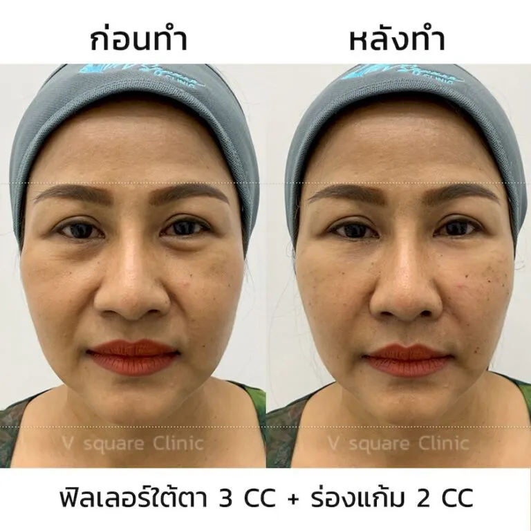 รีวิวก่อน-หลังการฉีดฟิลเลอร์จูวีเดิม