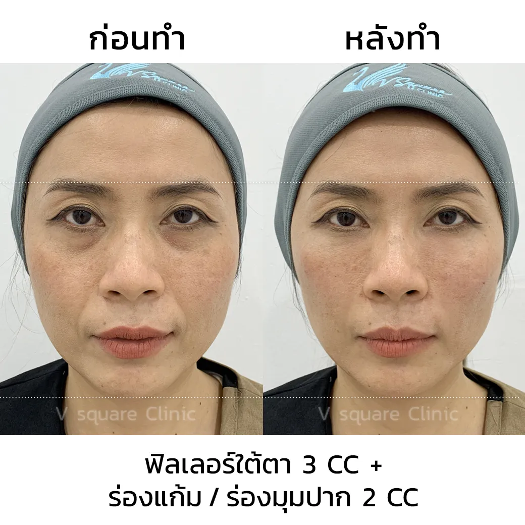 รีวิววก่อน-หลังฉีดฟิลเลอร์ Juvederm